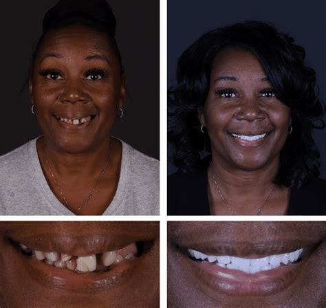 JAX Dental Implants & Dentures 